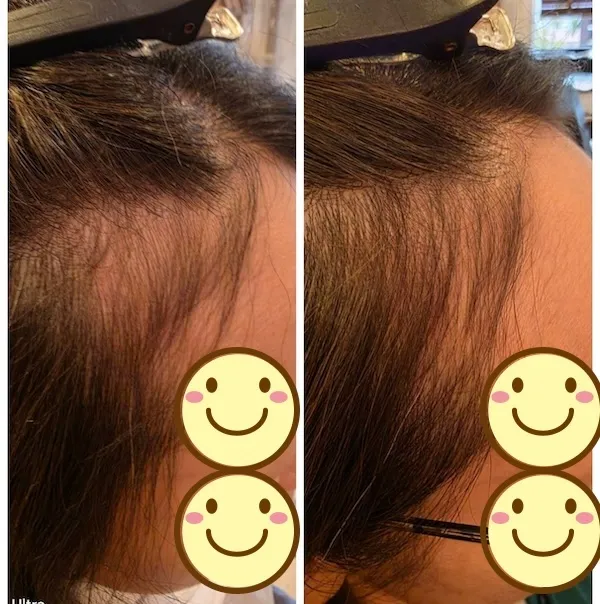 こめかみ エイジングショット Before/After 9