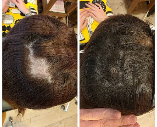 円形脱毛症 エイジングショット Before/After 9