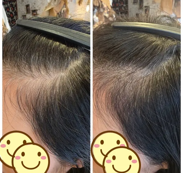 こめかみ エイジングショット Before/After 9