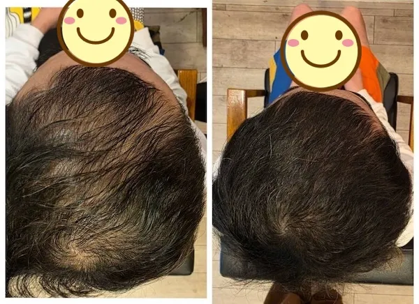 頭皮エイジングショット Before/After 9