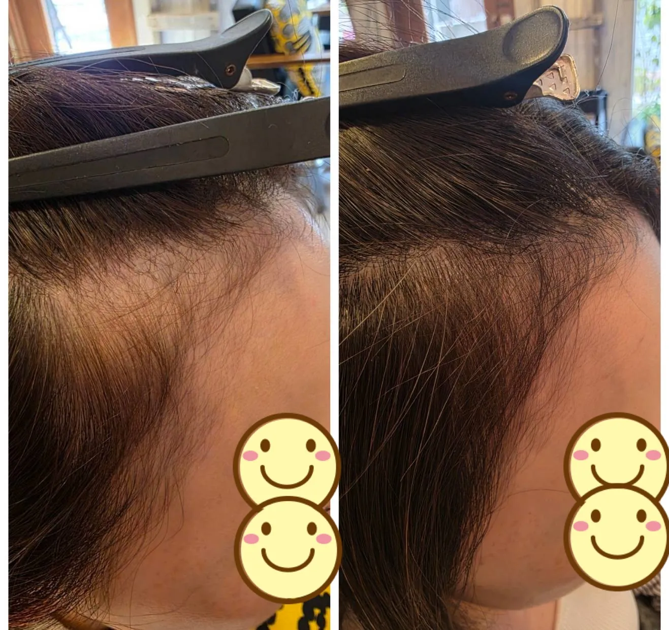 エイジングショット Before/After 11