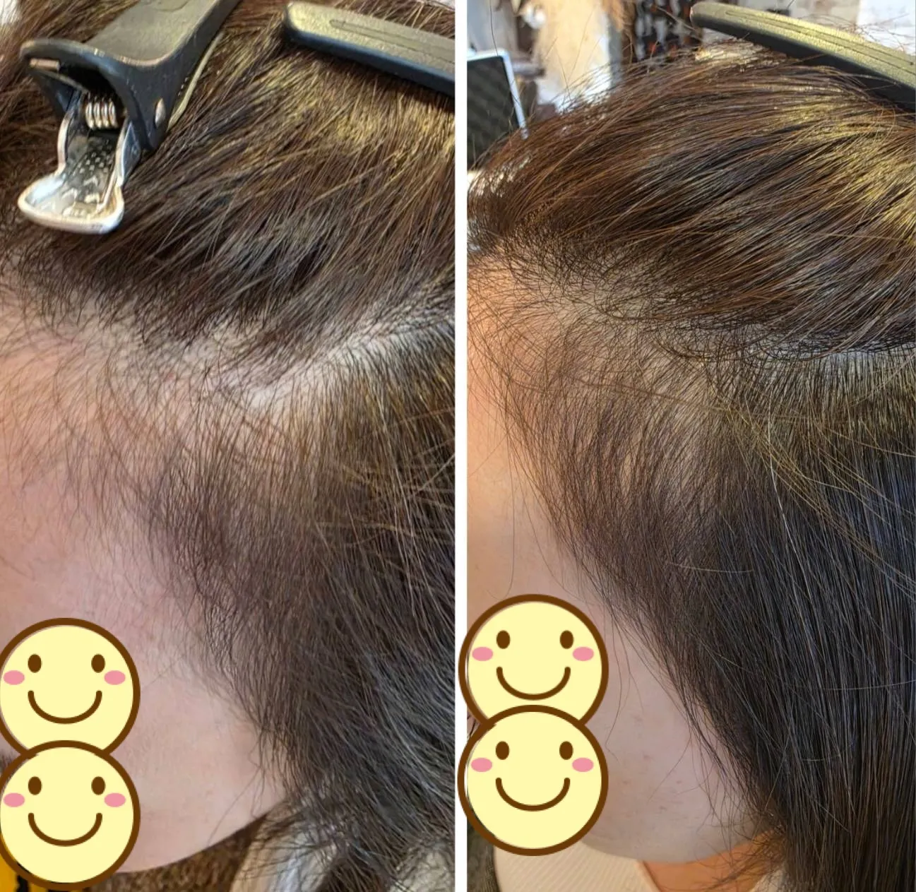 エイジングショット Before/After 11