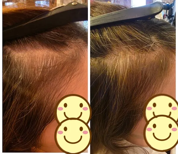 エイジングショット Before/After 10