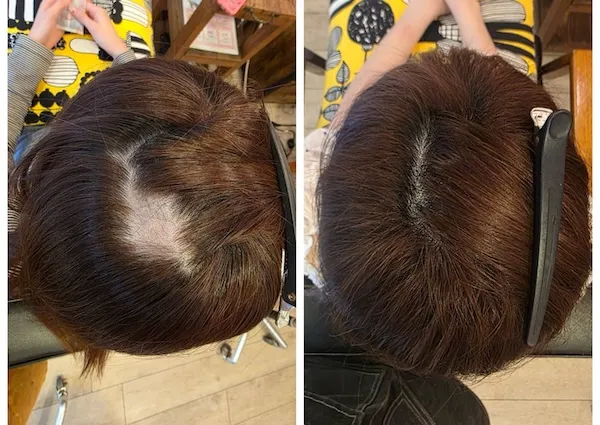 エイジングショット 円形脱毛Before/After 12