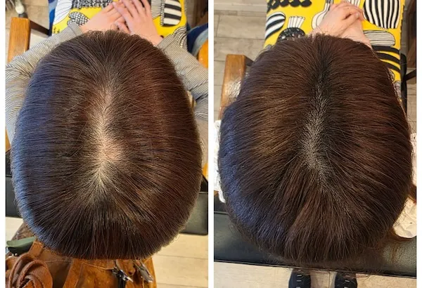エイジングショット 円形脱毛Before/After 12